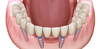 Full arch of teeth supported by All-on-4 implants in lower jaw