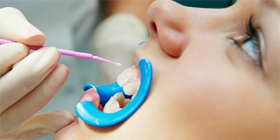 A person receiving a fluoride varnish.