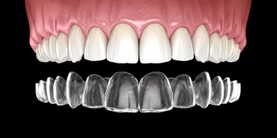 3D illustration of upper arch and ClearCorrect aligner