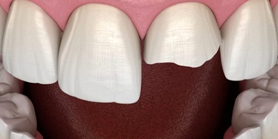 Model of a chipped front tooth.