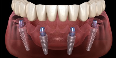 Implant-retained dentures