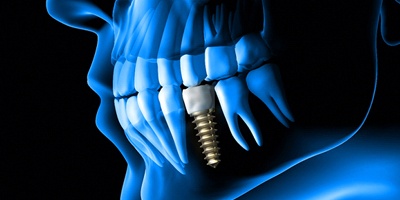 Implant in jaw