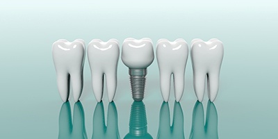 Diagram of teeth with a dental implant in Anthem in the center.