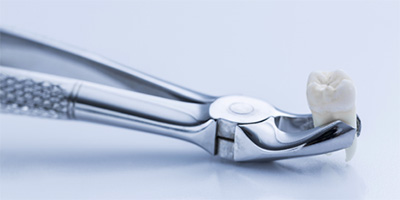 Metal clasp holding extracted tooth